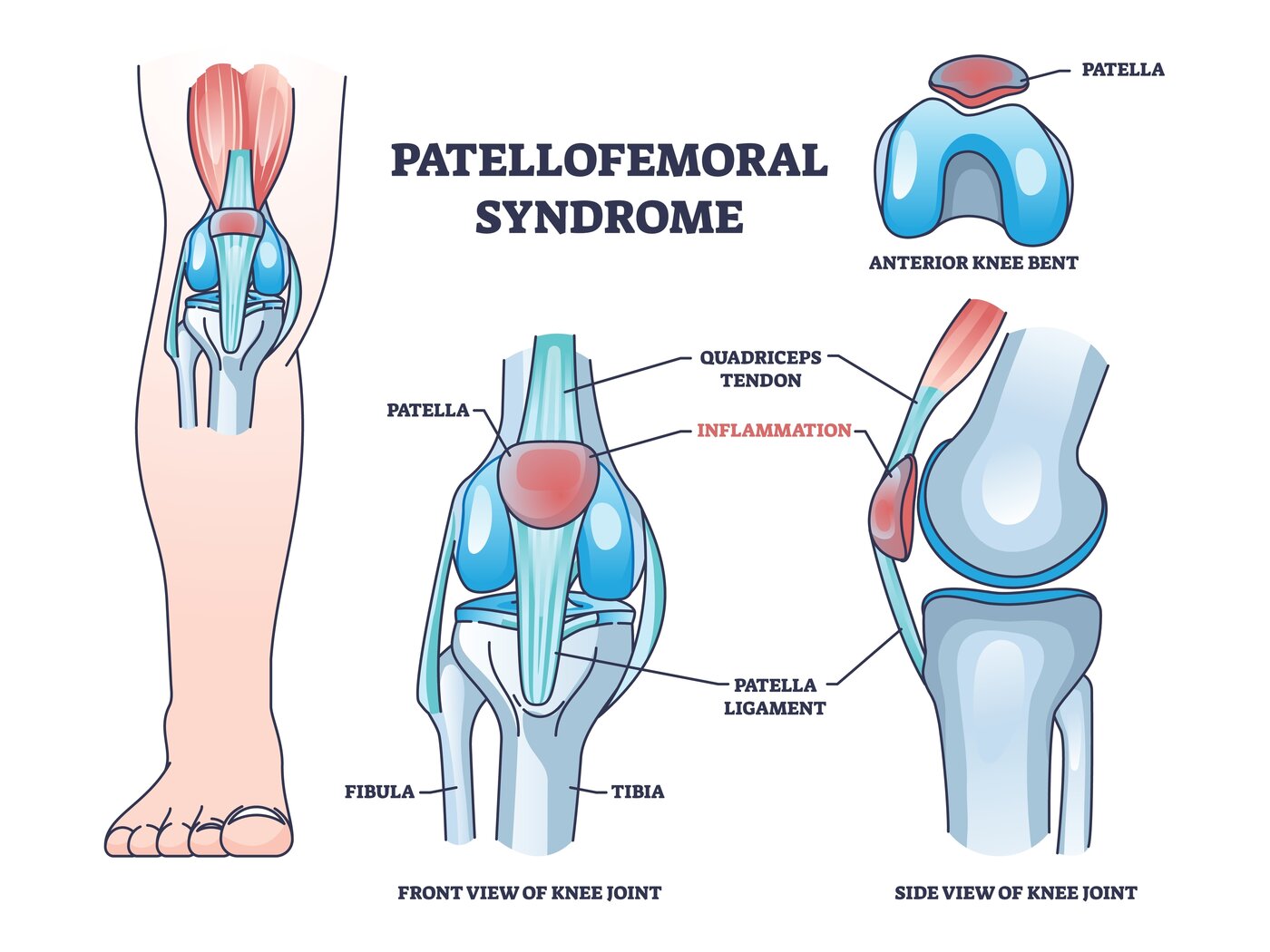 Runner's Knee (Patellofemoral Pain) anatomy diagram
