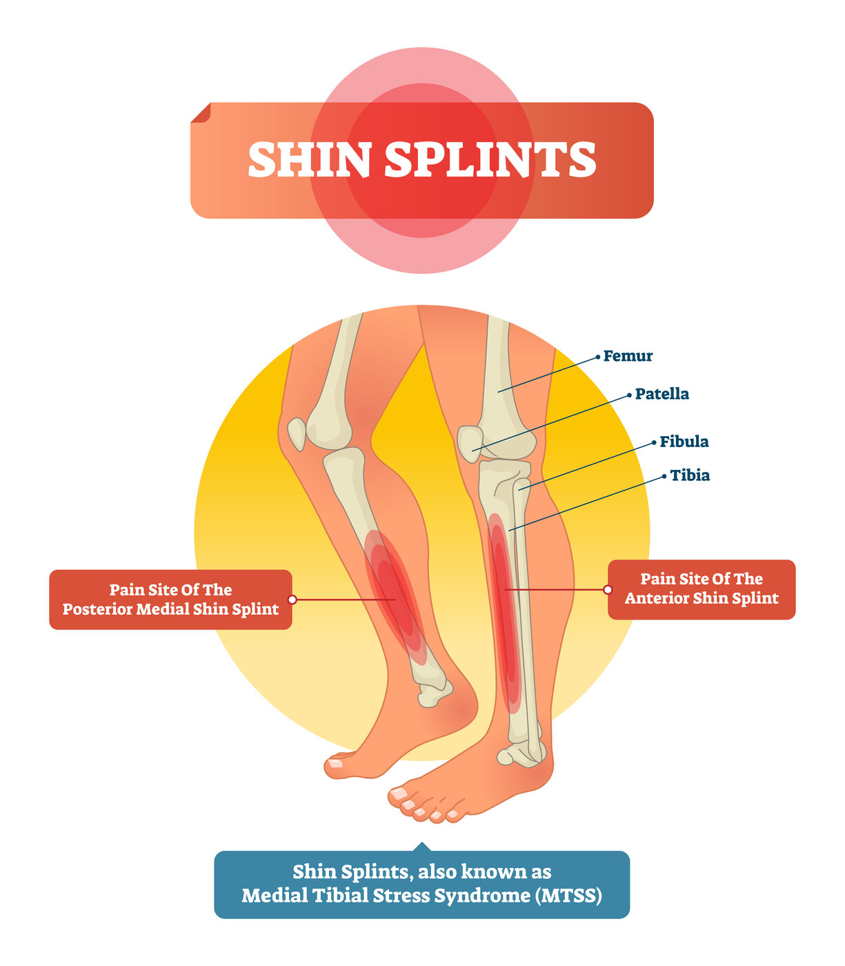 Shin Splints (Medial Tibial Stress Syndrome) anatomy diagram