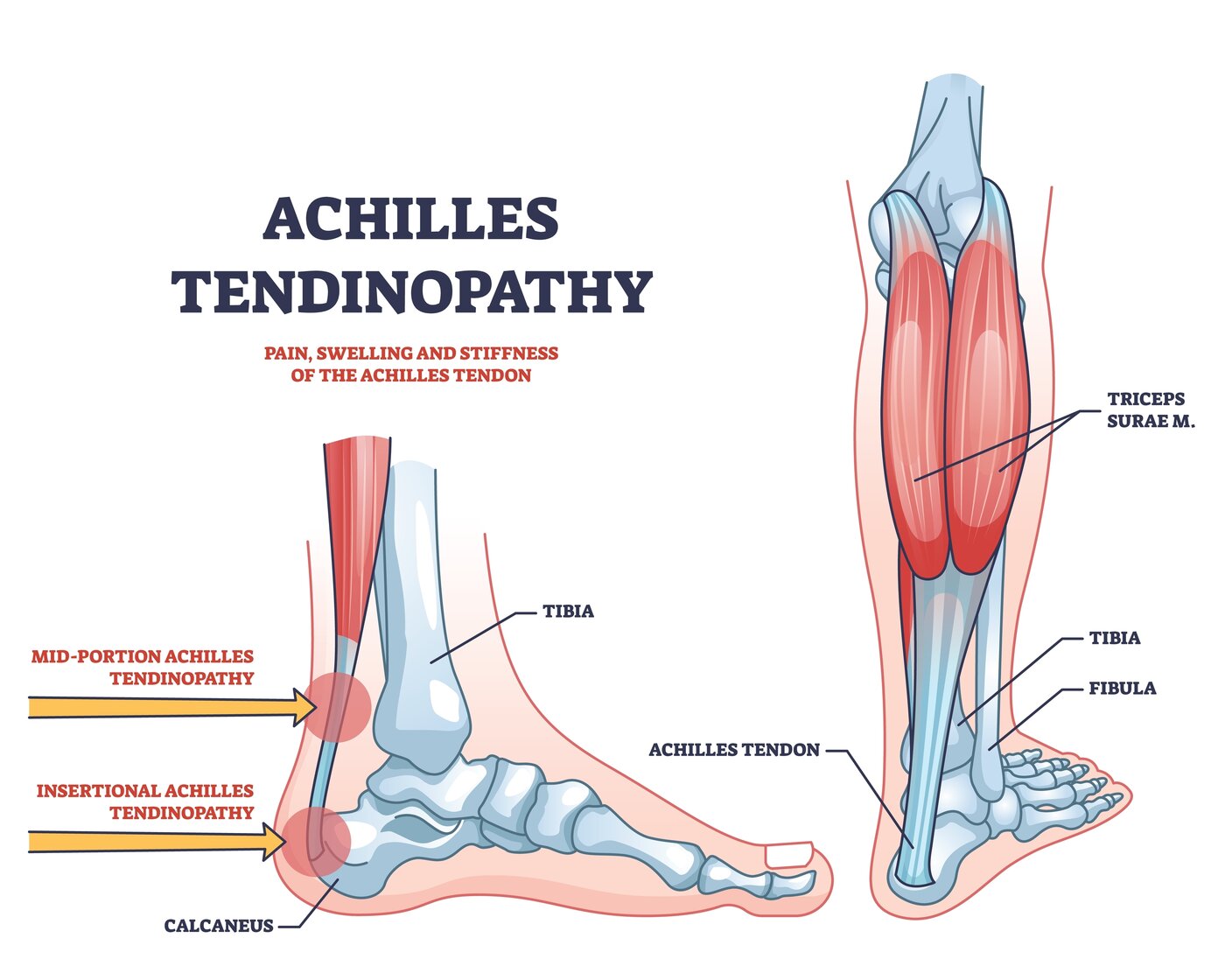 Achilles Tendinopathy anatomy diagram