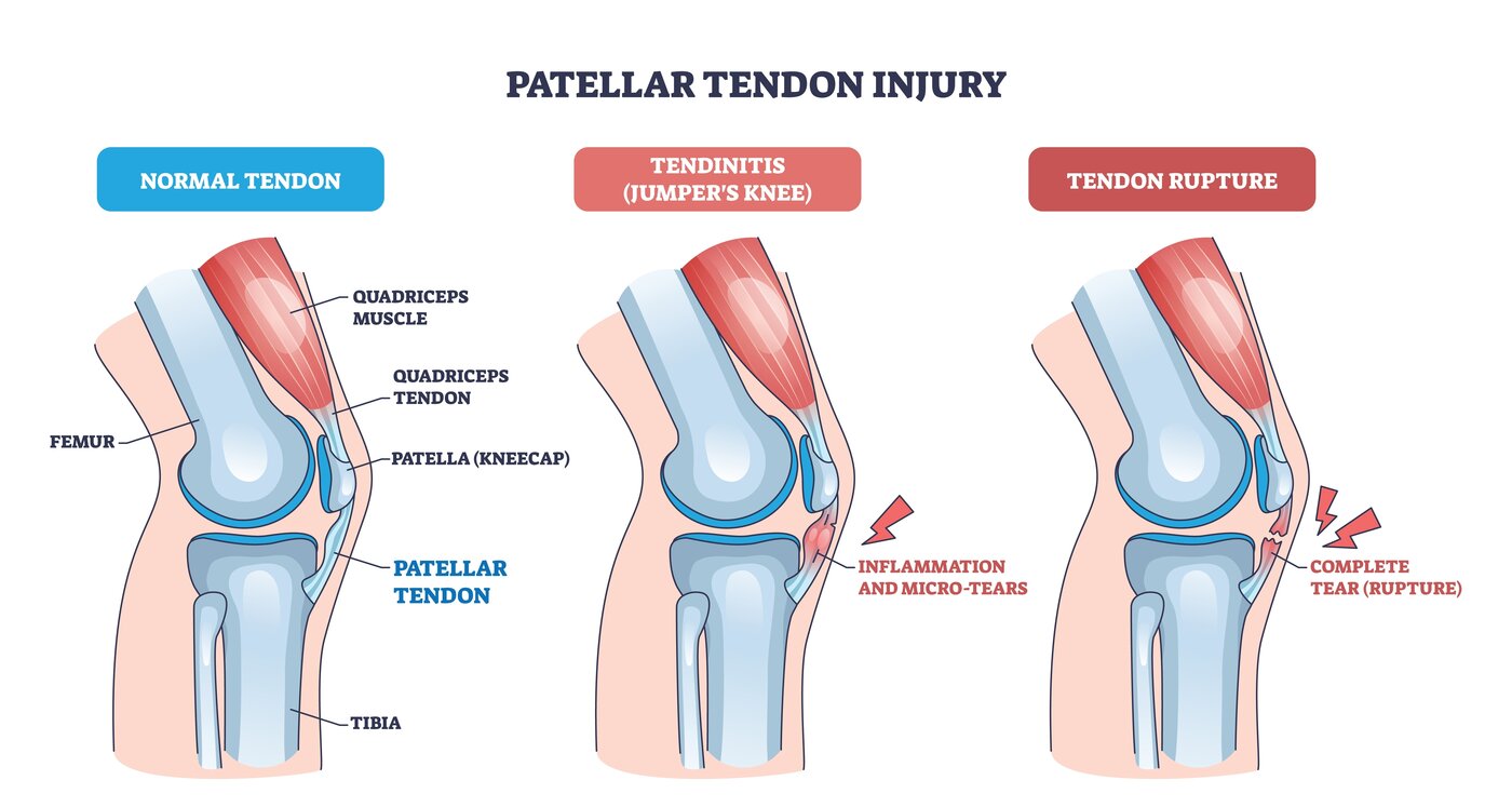 Patellar Tendinopathy (Jumper's Knee) anatomy diagram