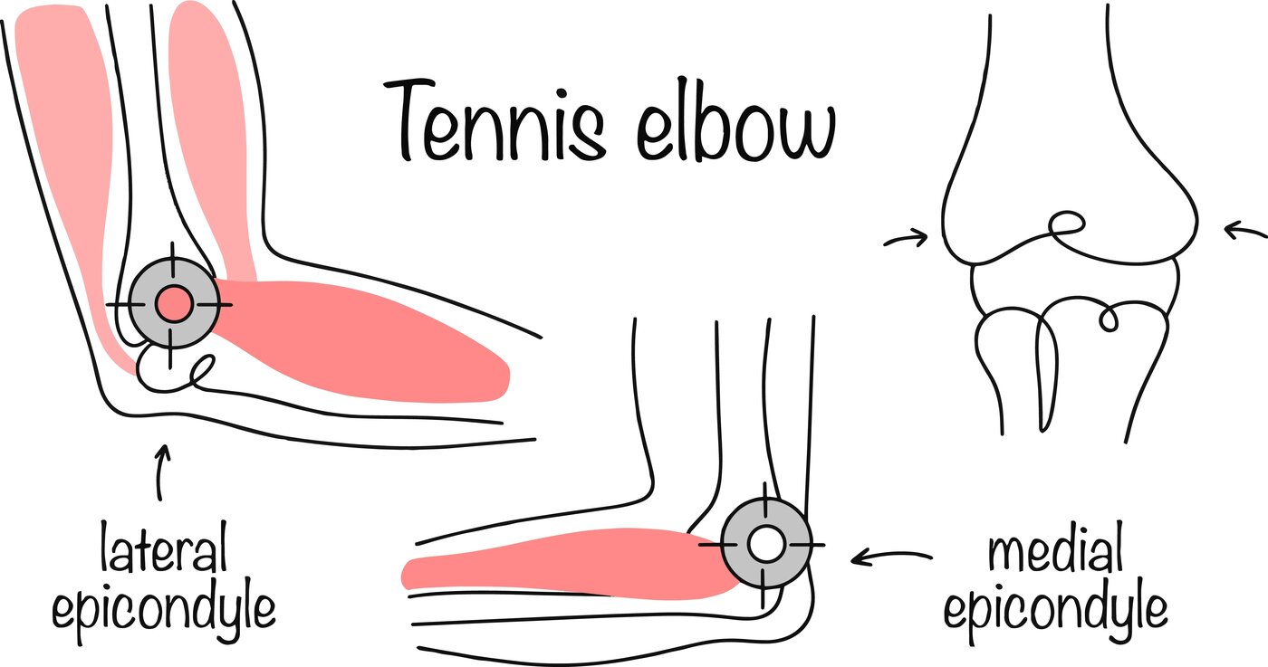 Tennis Elbow (Lateral Epicondylitis) anatomy diagram