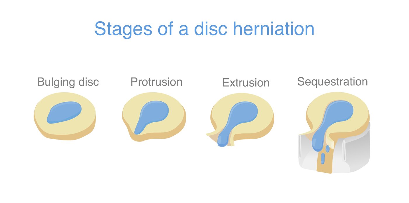 Herniated Disc anatomy diagram
