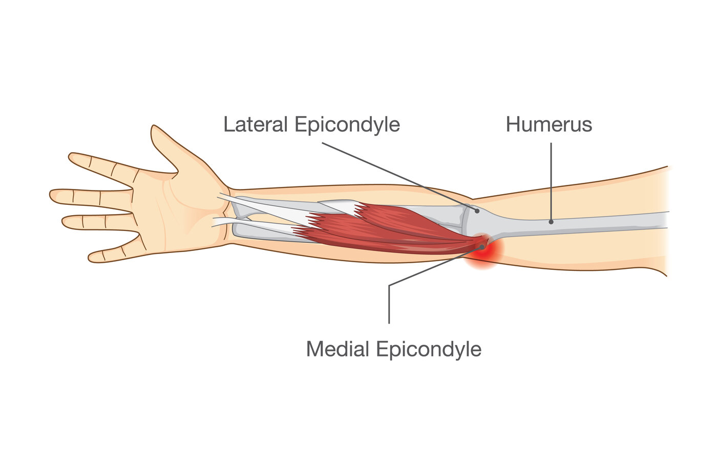Golfer's Elbow (Medial Epicondylitis) anatomy diagram
