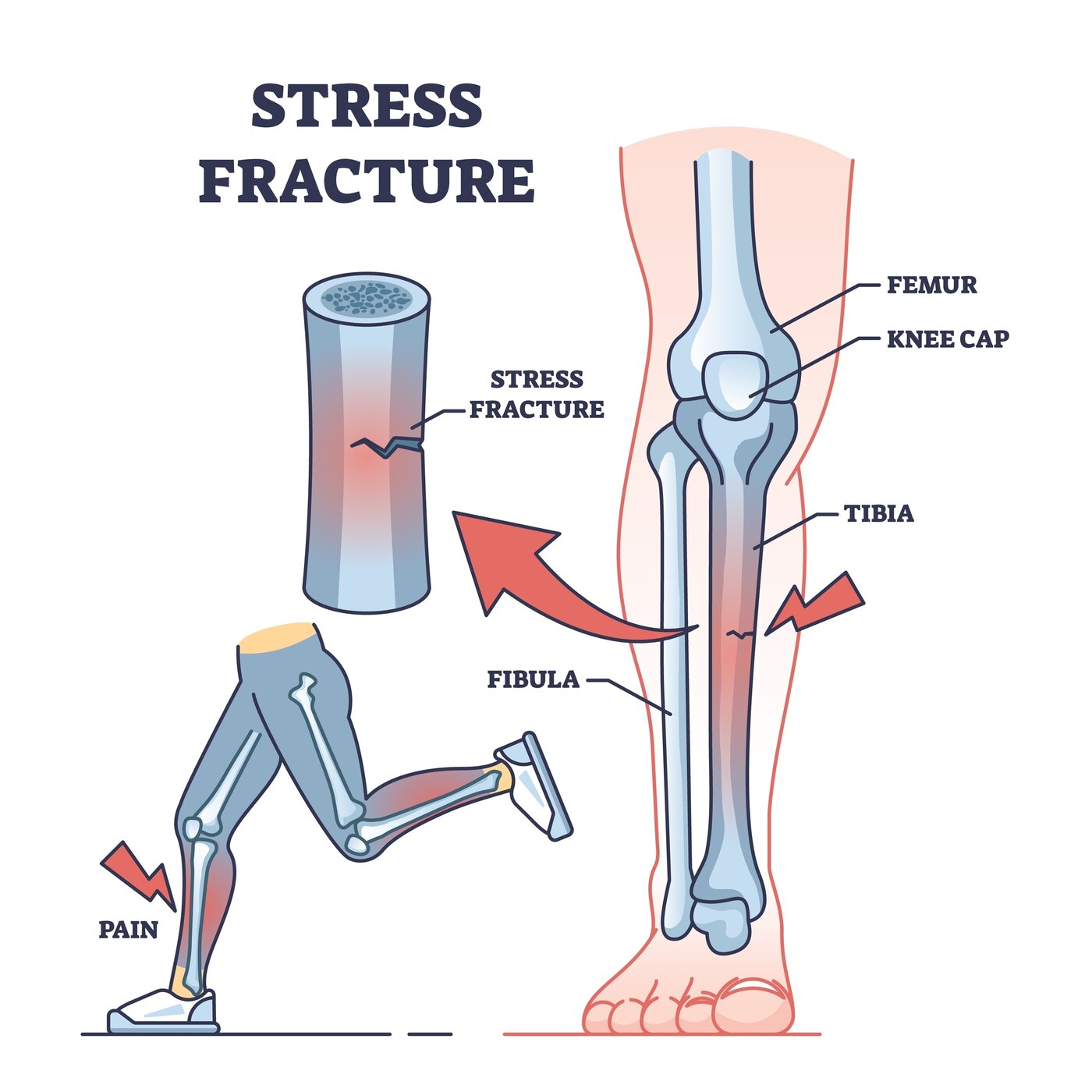 Bone Stress Injury / Stress Fracture anatomy diagram