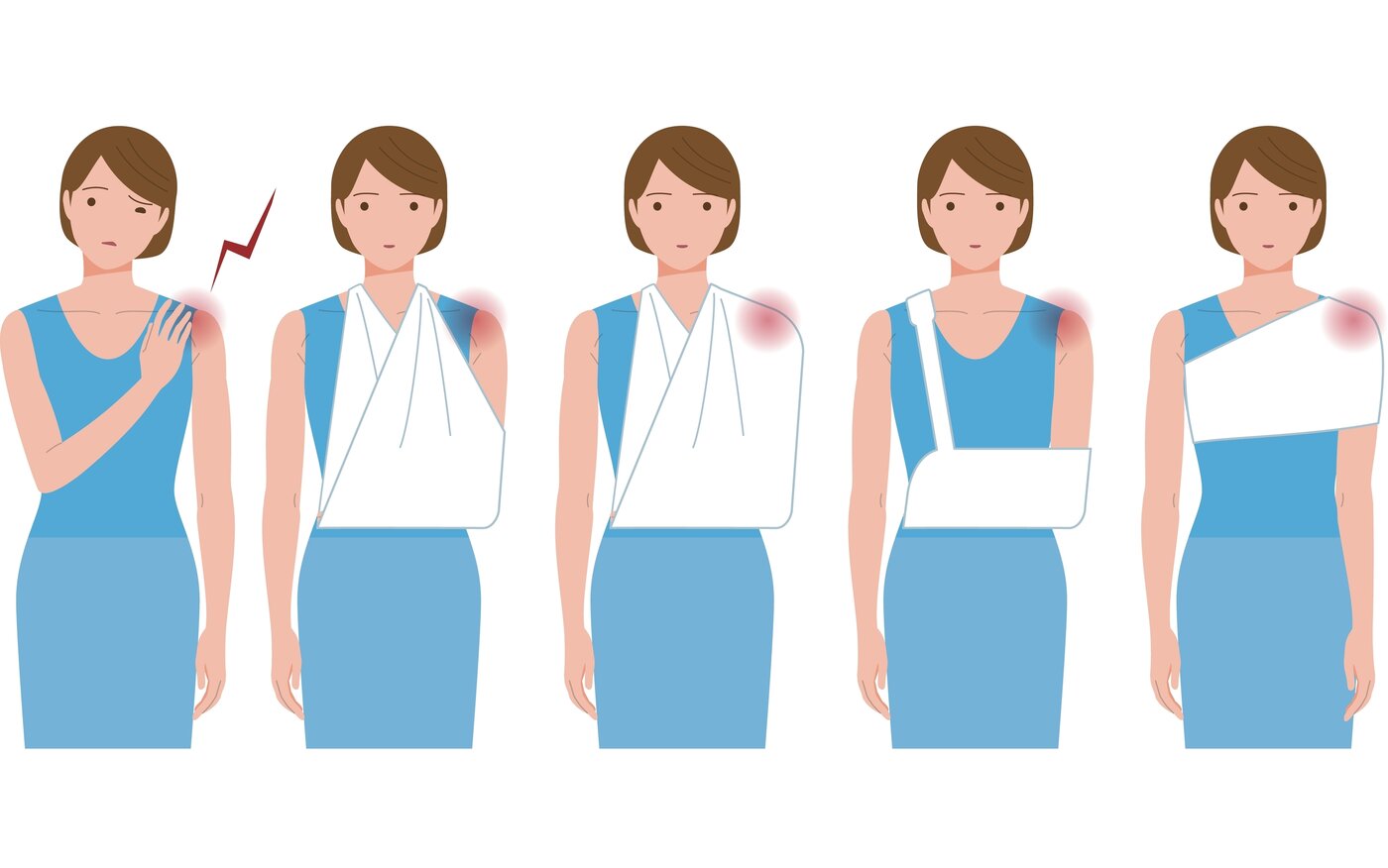 Frozen Shoulder (Adhesive Capsulitis) anatomy diagram