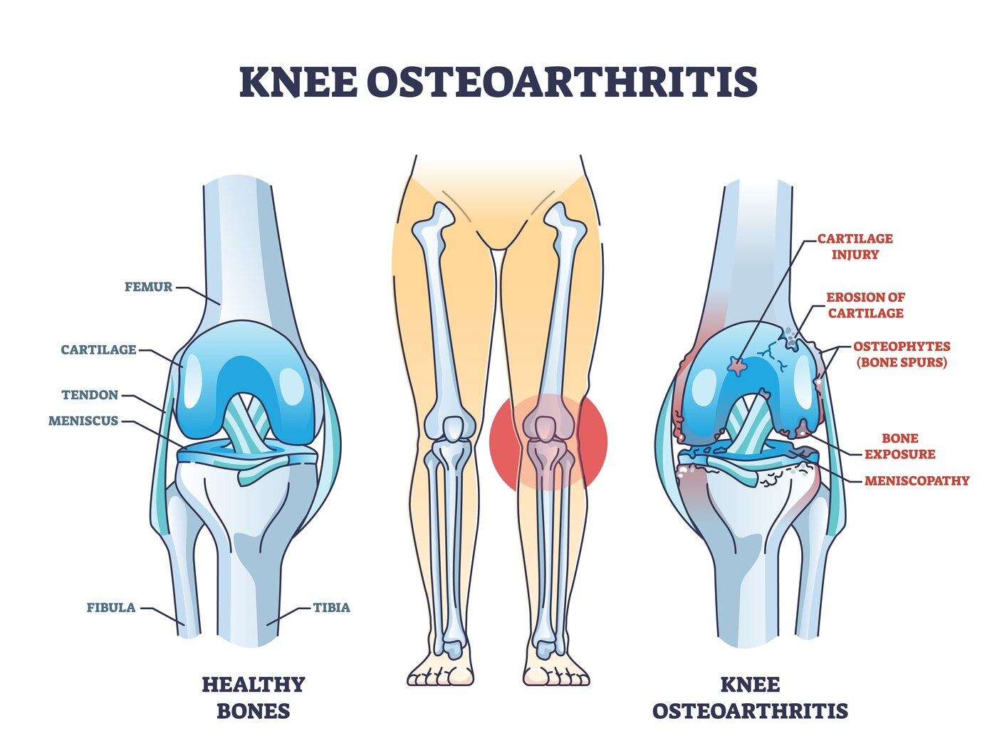 Knee Osteoarthritis anatomy diagram