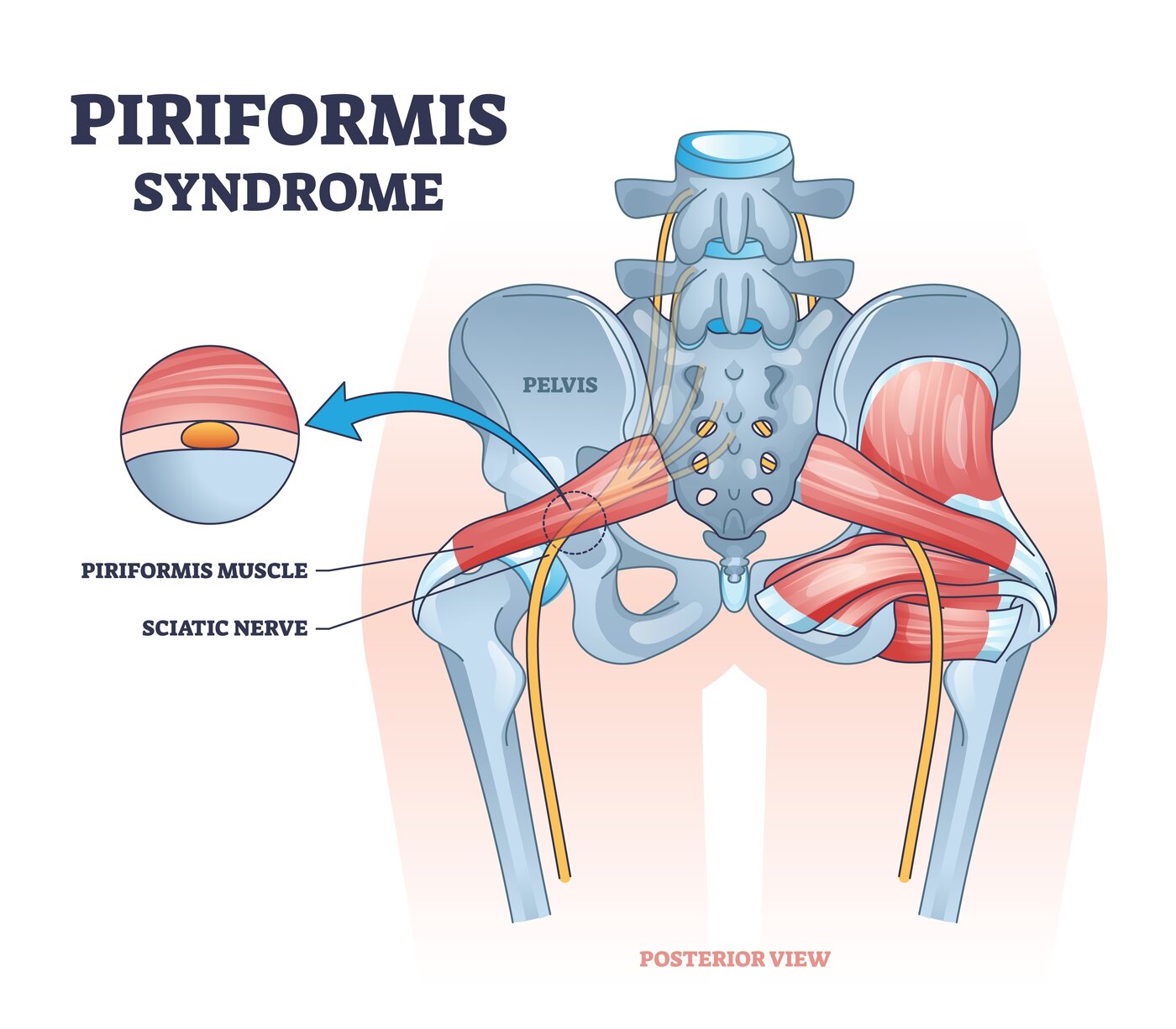 Piriformis Syndrome anatomy diagram
