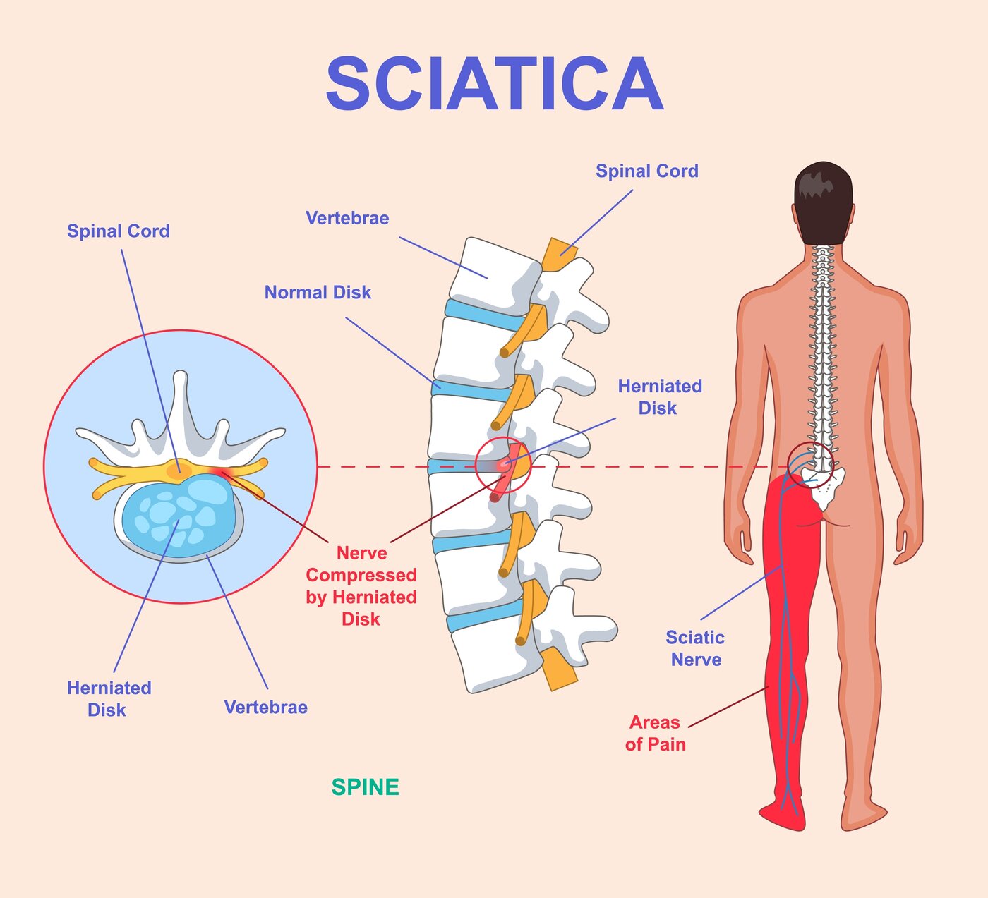 Sciatica / Low Back Pain anatomy diagram