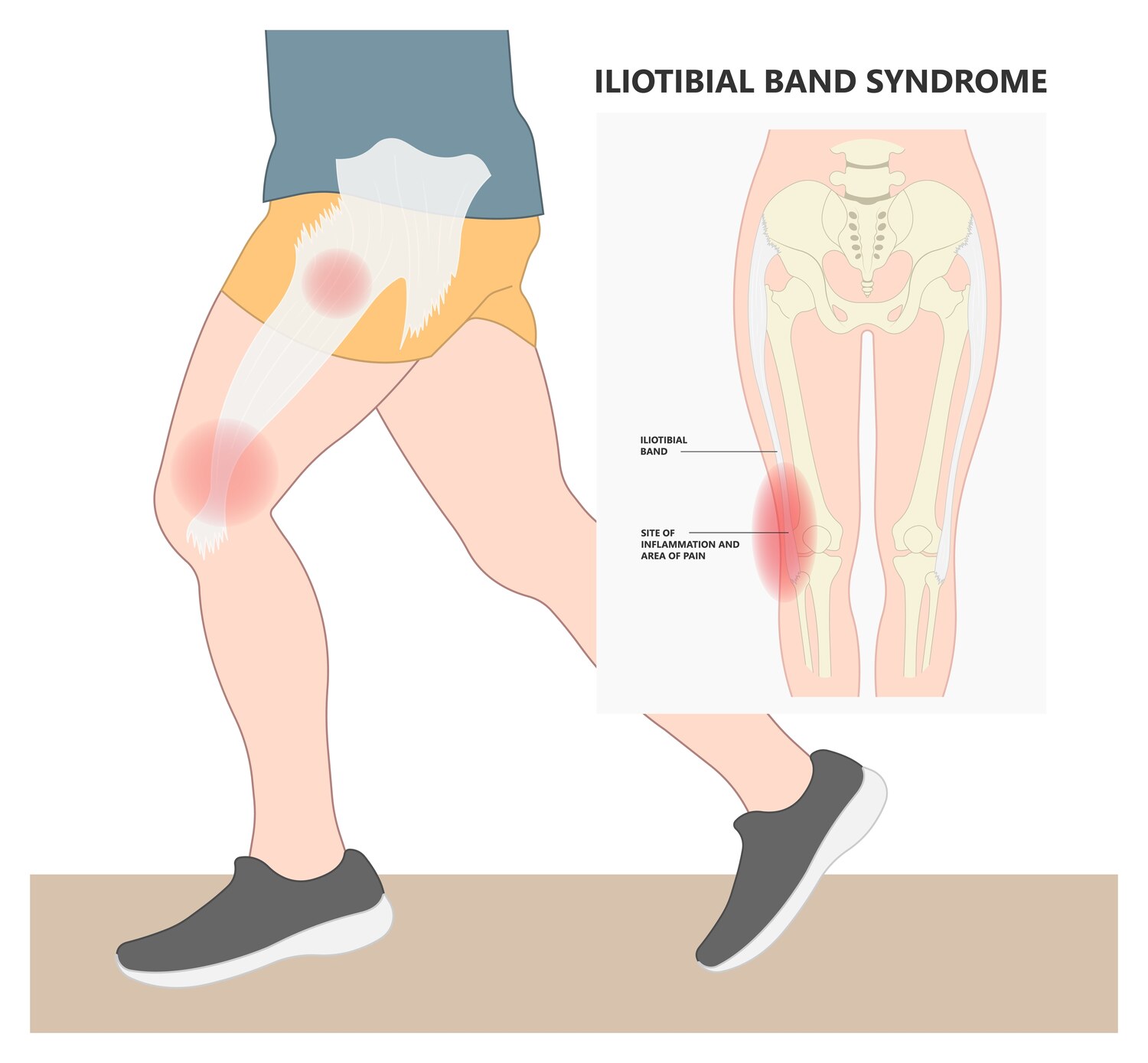 IT Band Syndrome anatomy diagram