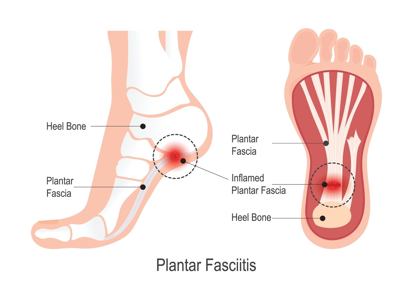 Plantar Fasciitis / Heel Spur anatomy diagram