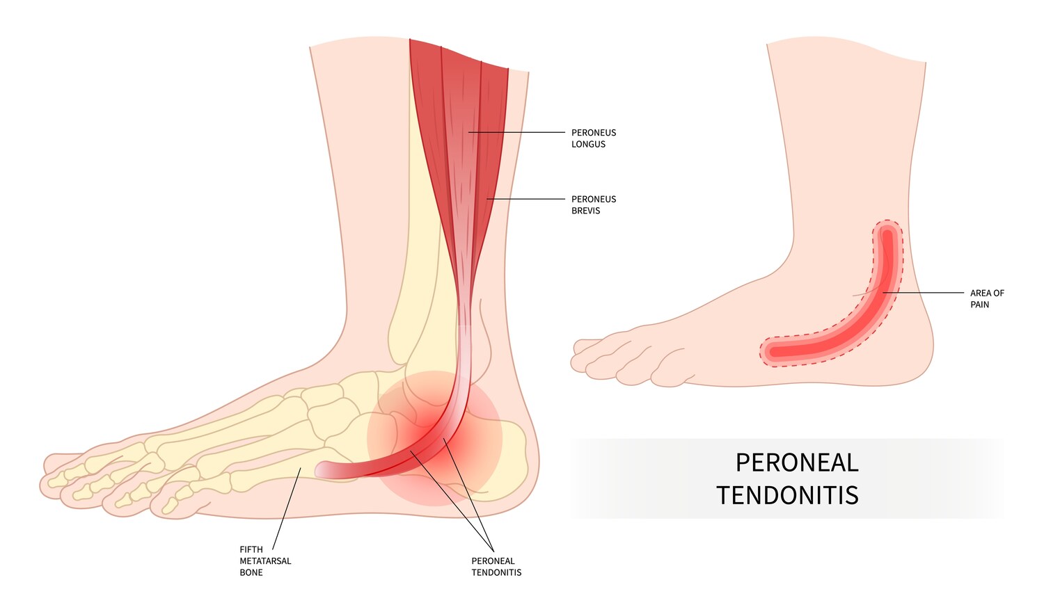 Posterior Tibial & Peroneal Tendon Pain anatomy diagram 2
