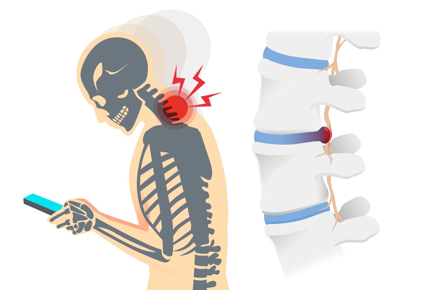 Neck & Upper Back Pain anatomy diagram