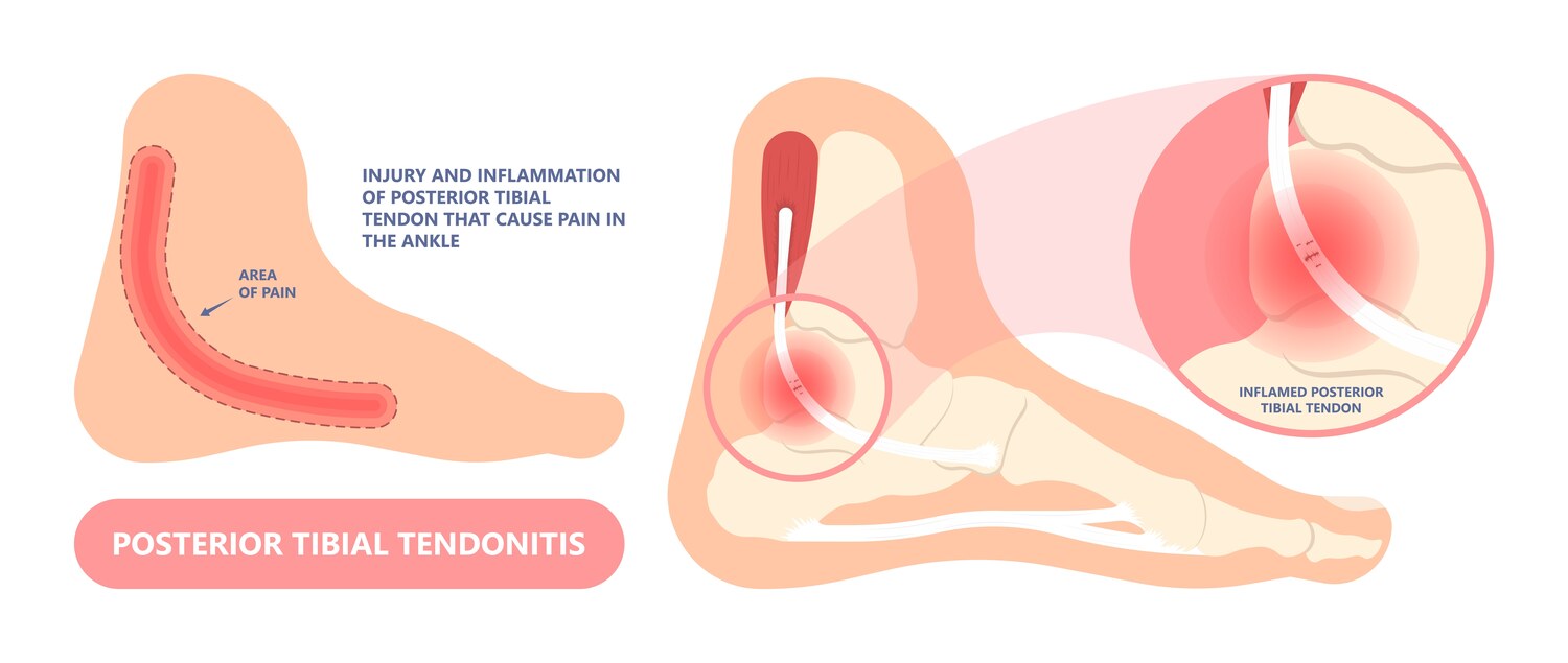 Posterior Tibial & Peroneal Tendon Pain anatomy diagram 1