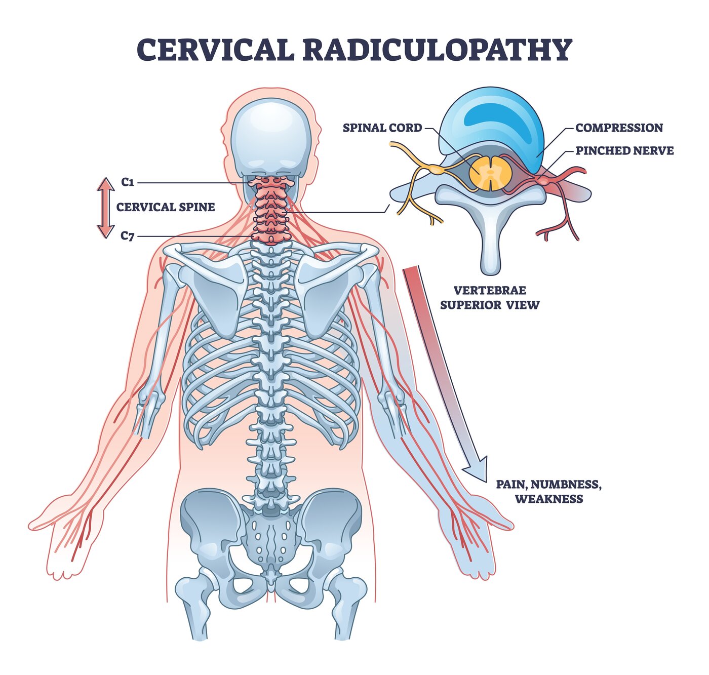 Pinched Nerve (Cervical Radiculopathy) anatomy diagram