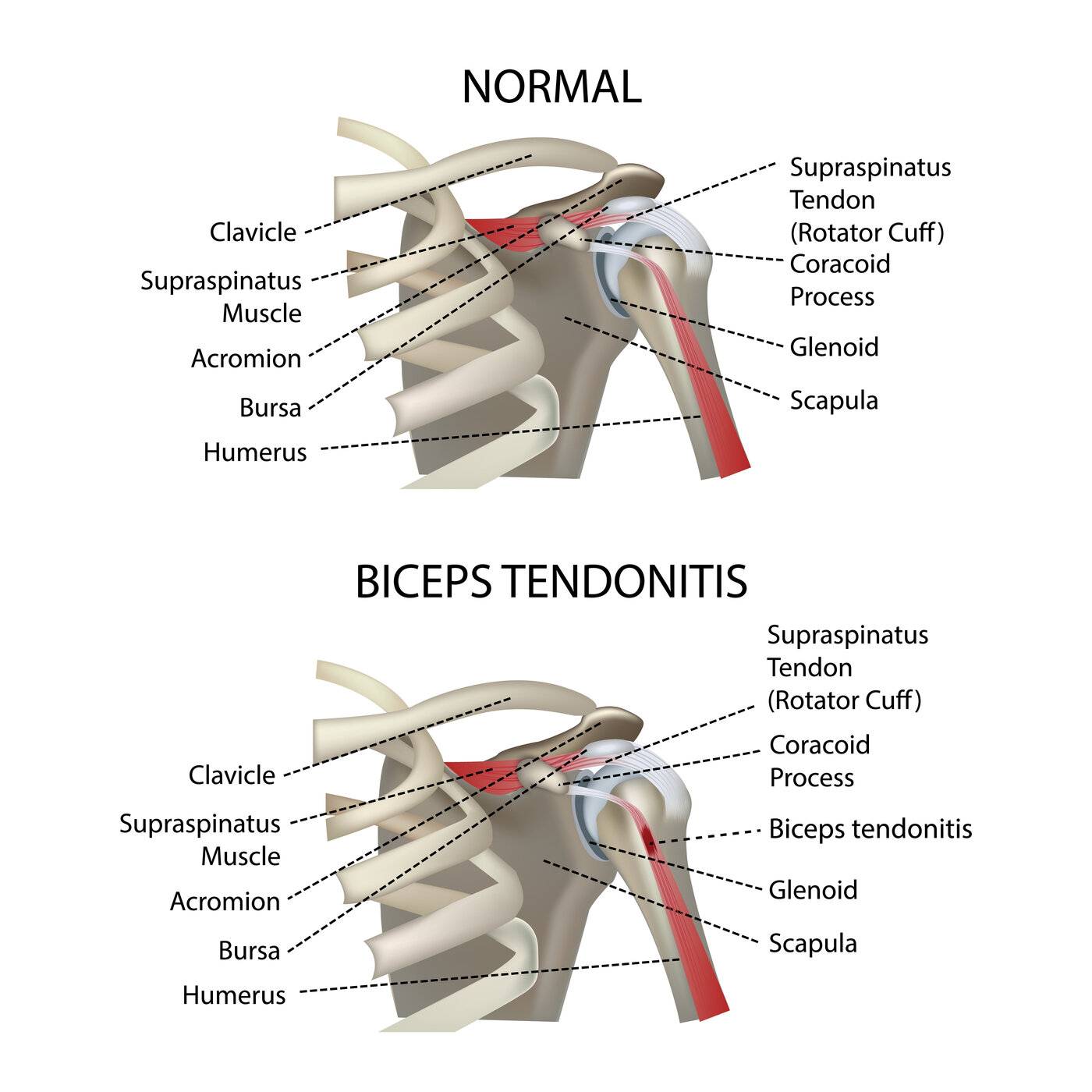 Biceps Tendinopathy anatomy diagram