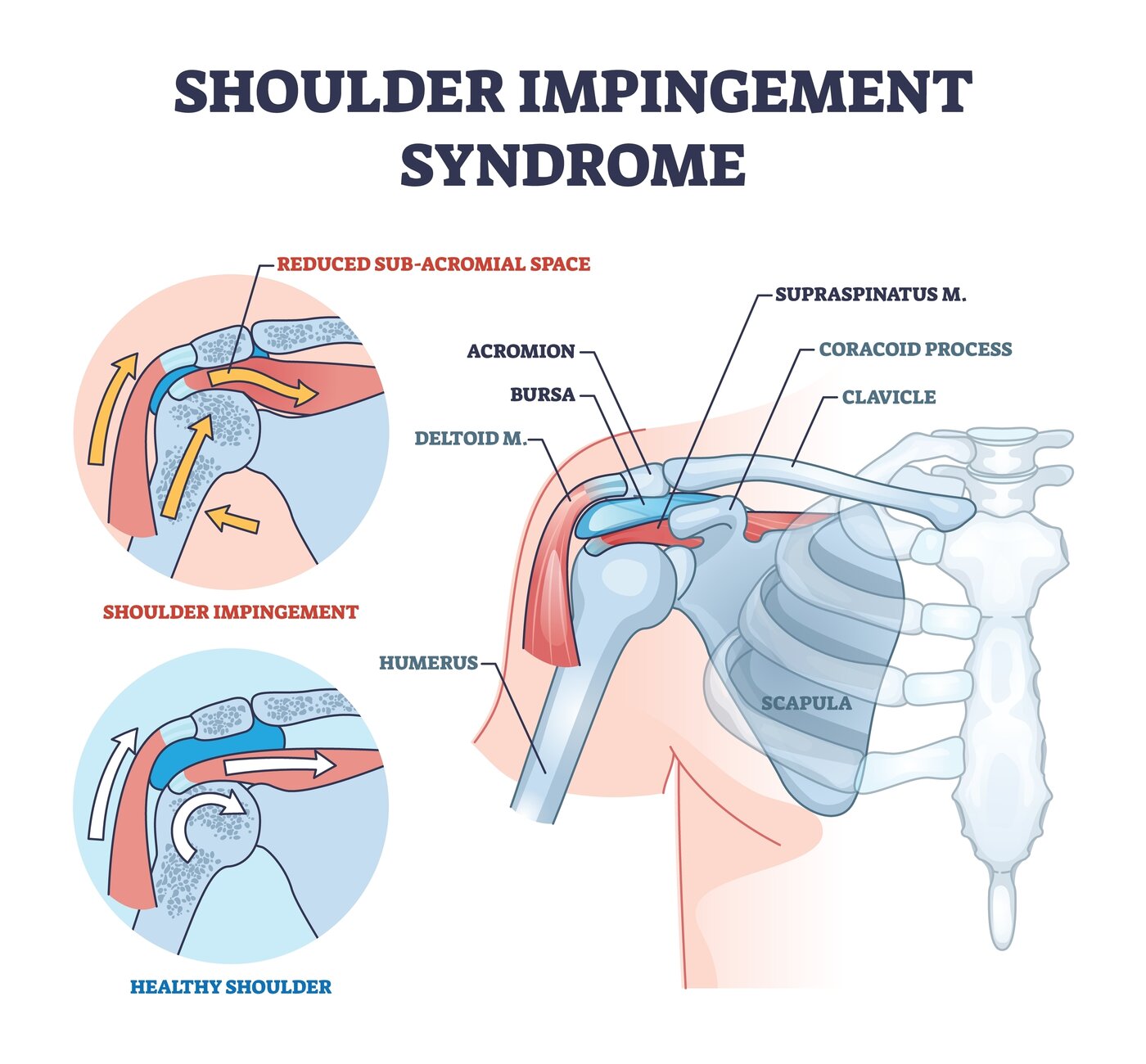 Shoulder Impingement anatomy diagram